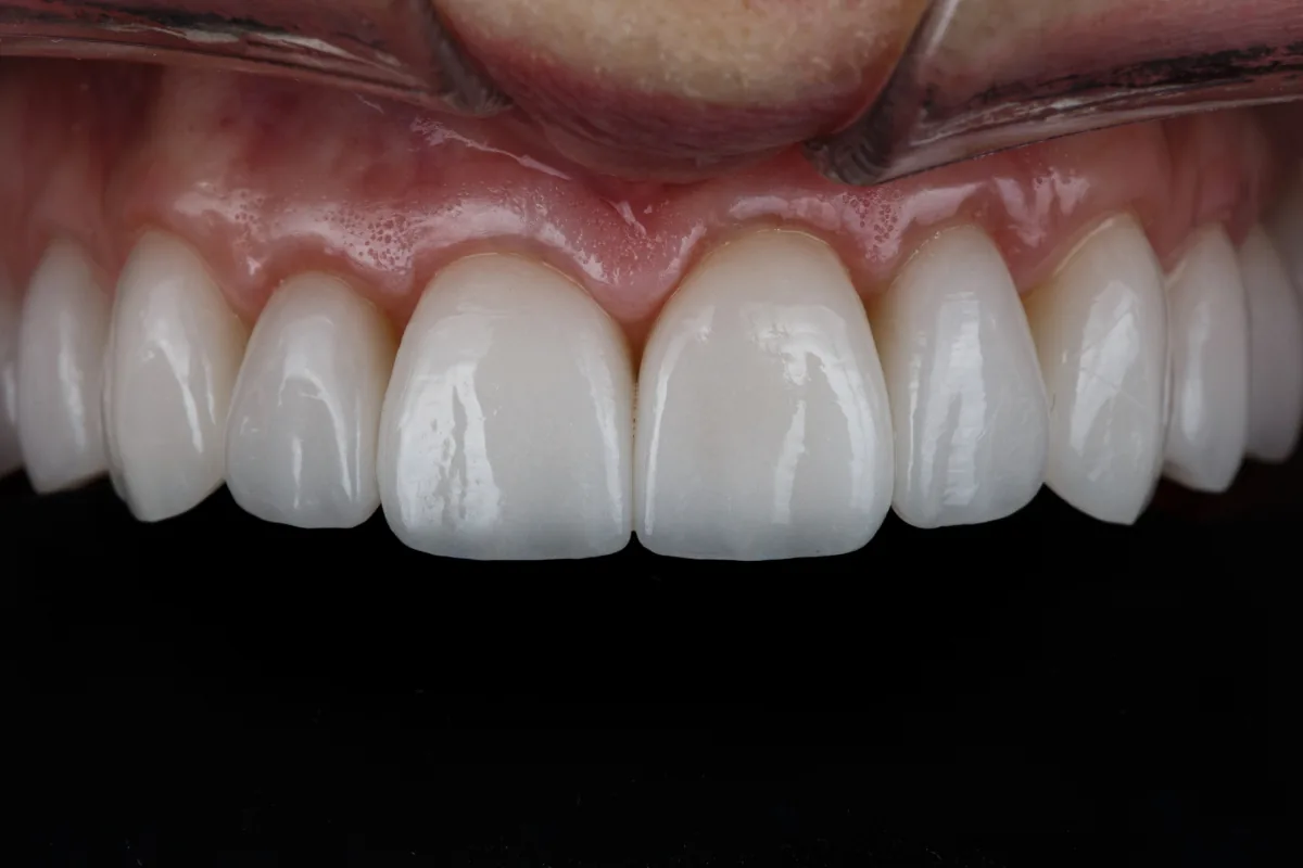 Smile and tooth proportion analysis