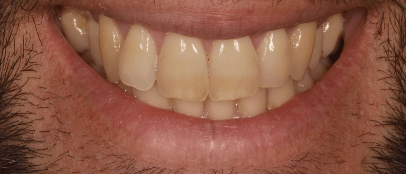 Eclaircissement-Blanchiment-Dentaire