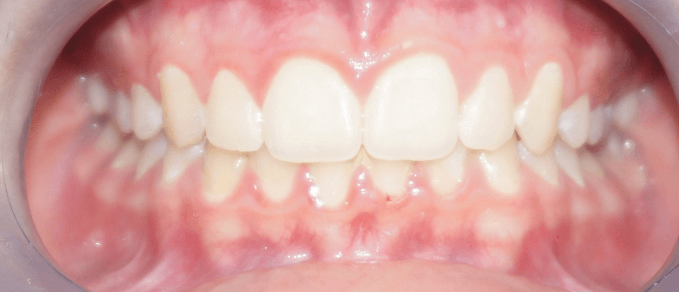 Après traitement orthodontique