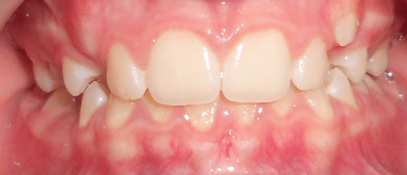 Avant traitement orthodontique