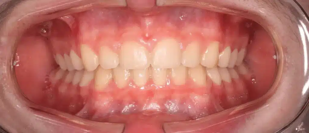 Orthodontie invisalign invisible apres