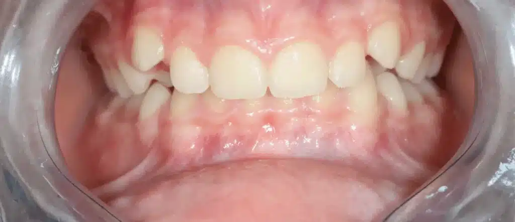 Orthodontie invisalign invisible avant