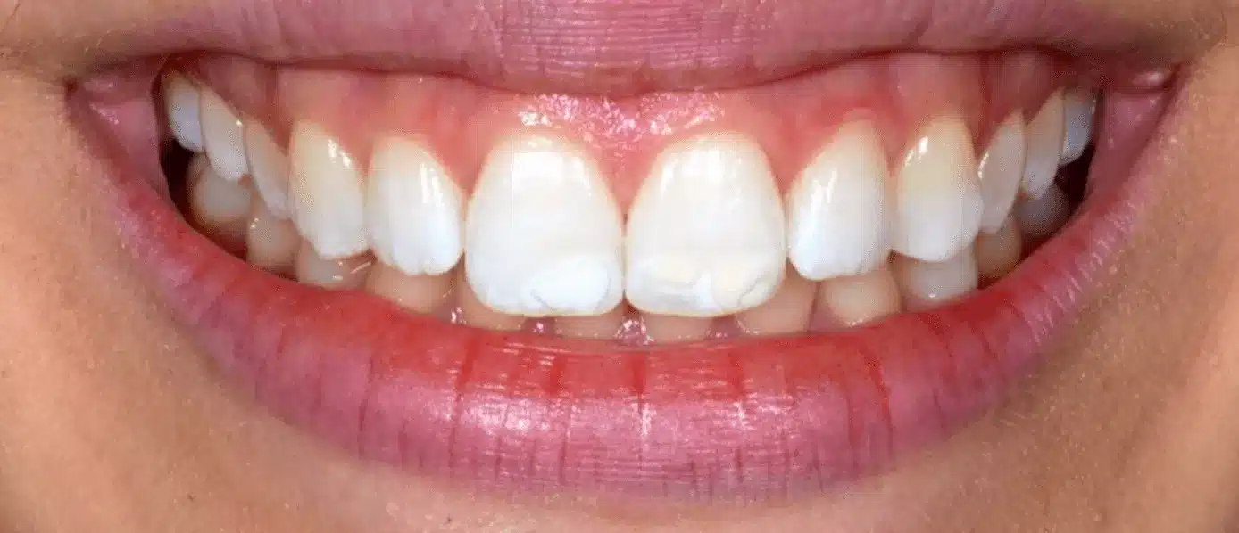 Elimination des taches blanches sur les dents avants