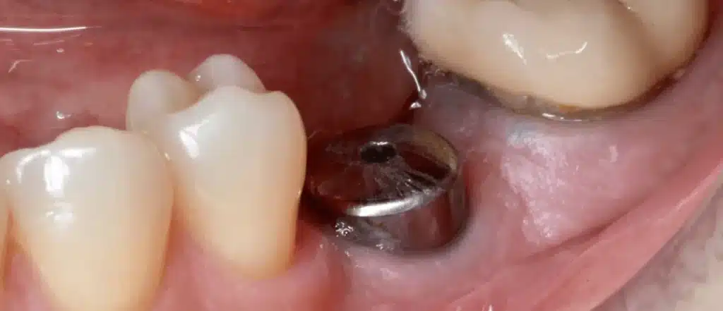 Dental implant surgeon in Paris after