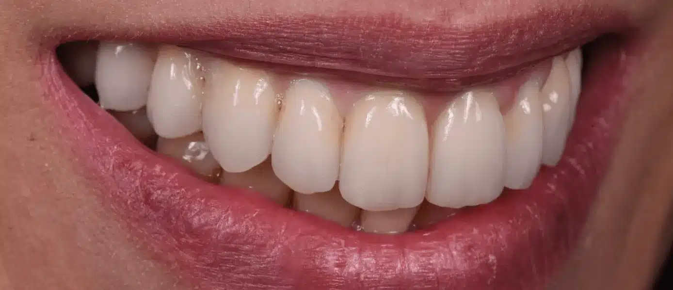 Dentiste Implant dentaire apres