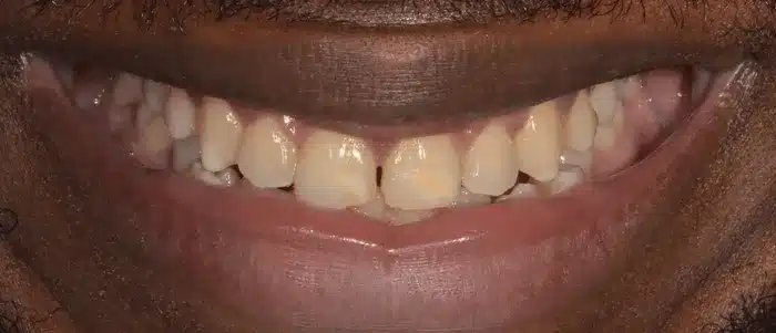 Blanchiment dentaire dentiste paris avant
