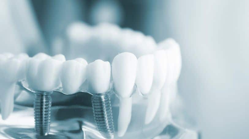 implants dentaires fast dentisterie