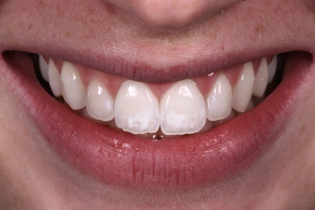 Taches jaunes sur les dents, après traitement au Cabinet Dentaire de la Madeleine
