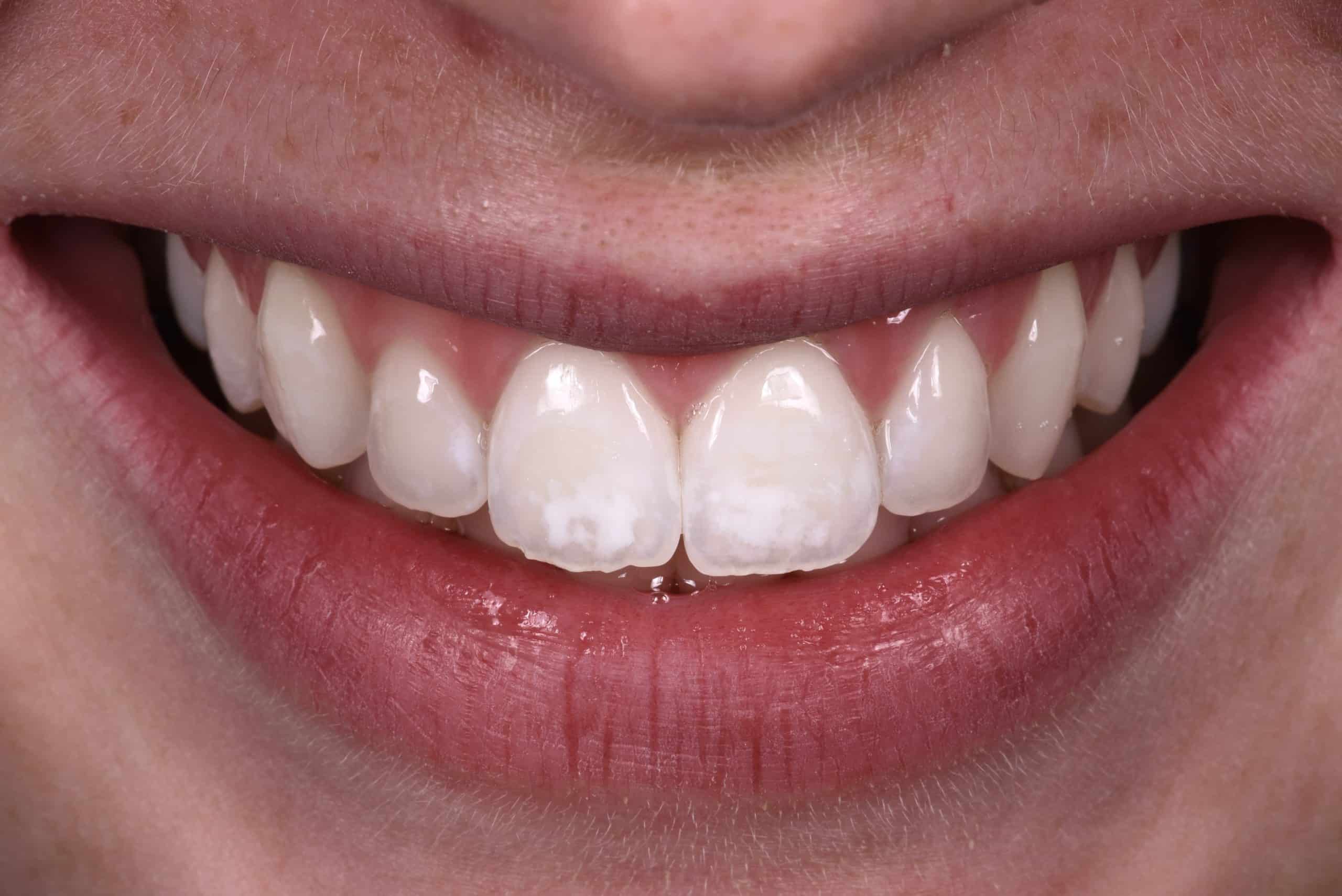 Taches jaunes sur les dents, après traitement au Cabinet Dentaire de la Madeleine