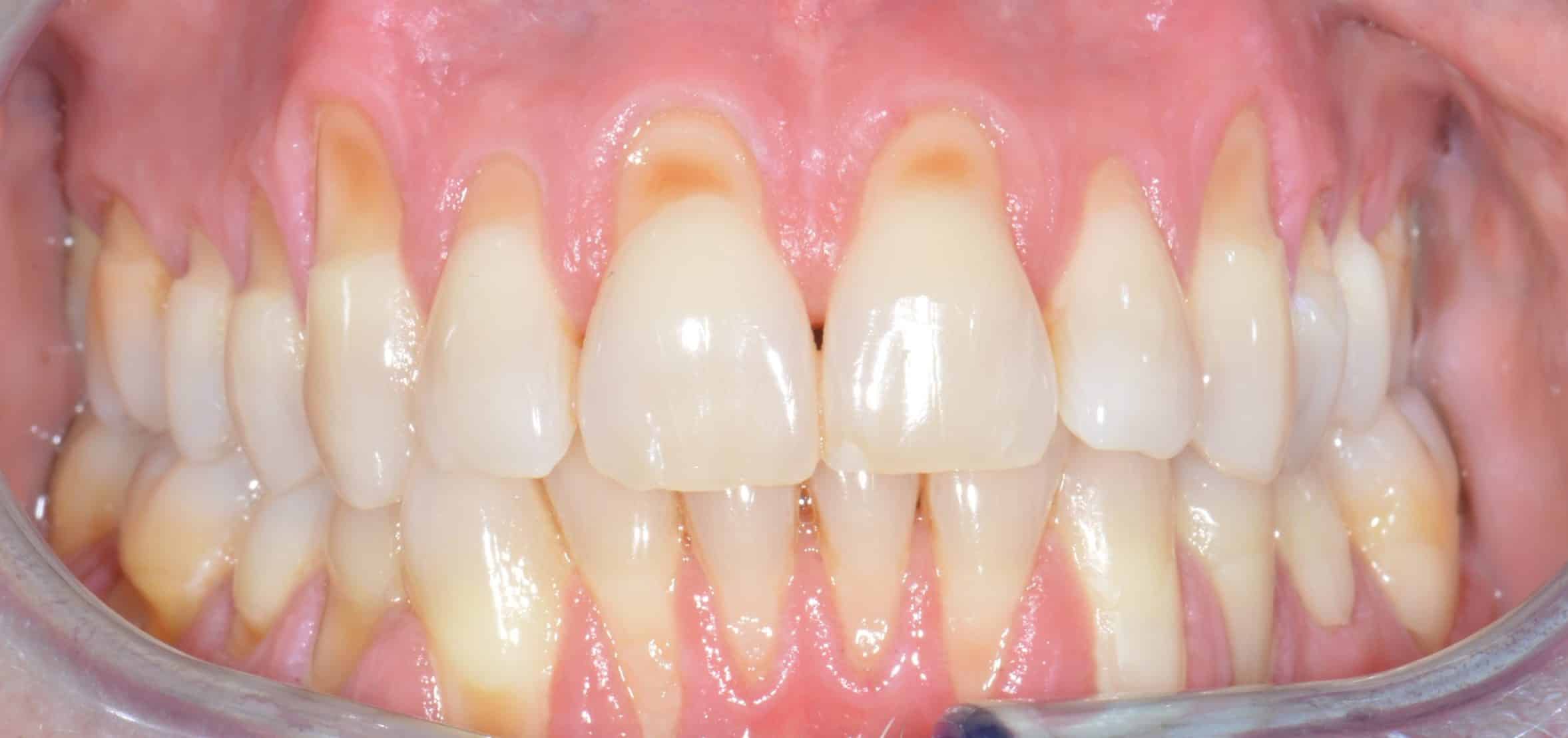 Avant greffe de gencive au Cabinet Dentaire de la Madeleine