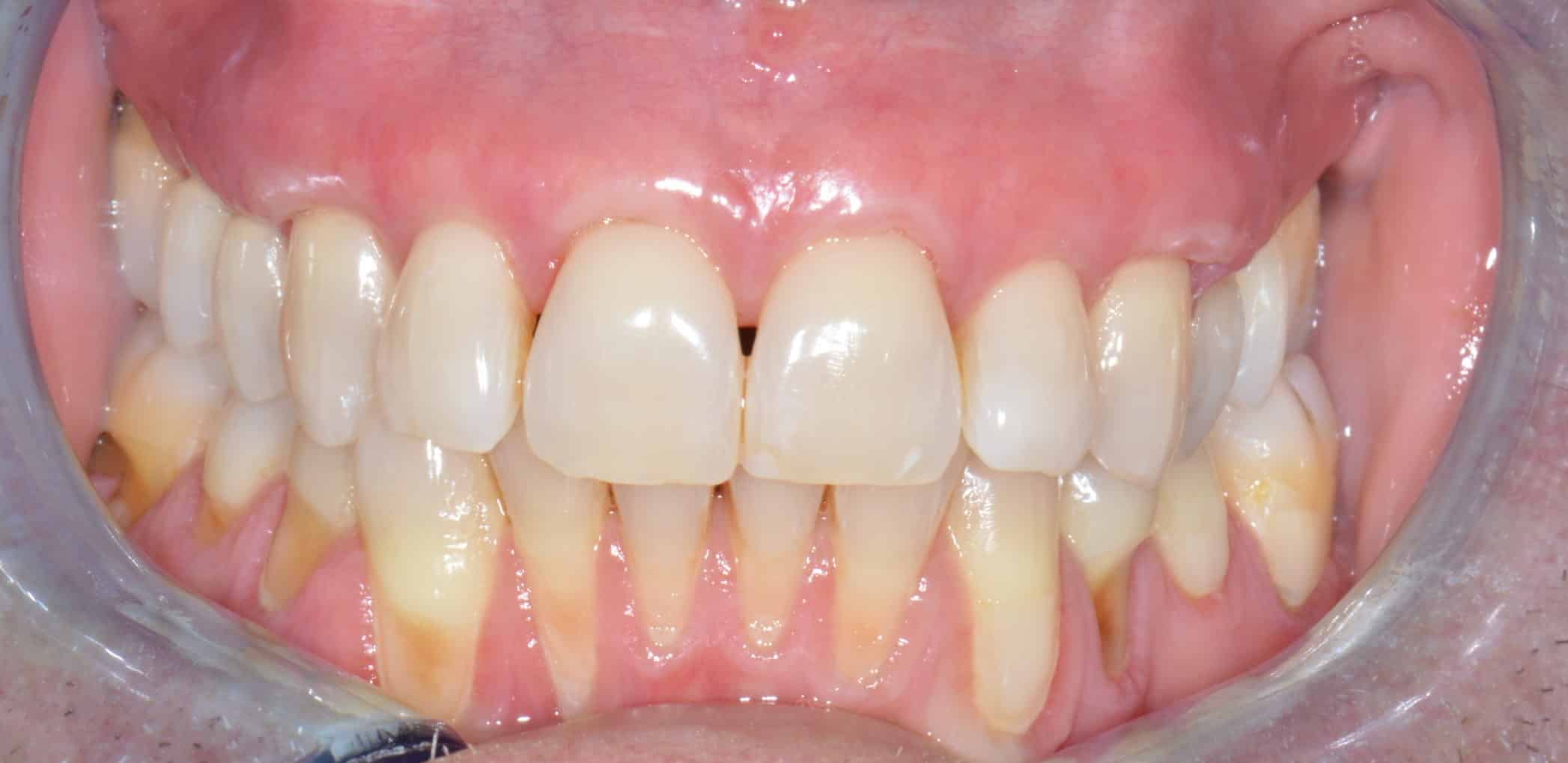 Après greffe de gencive au Cabinet Dentaire de la Madeleine