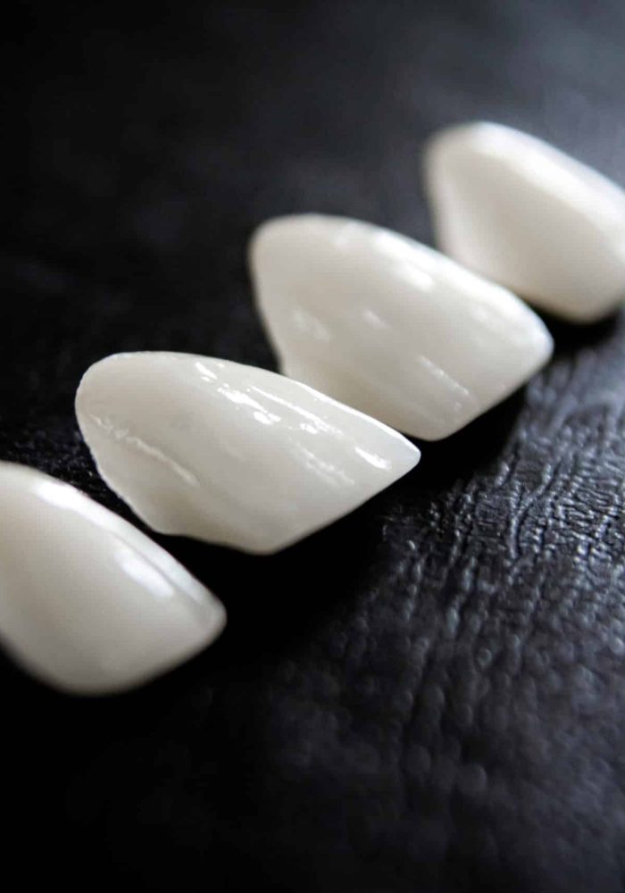 Facettes de dents